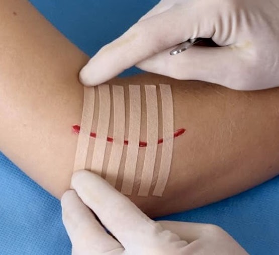 Interventii minim invazive